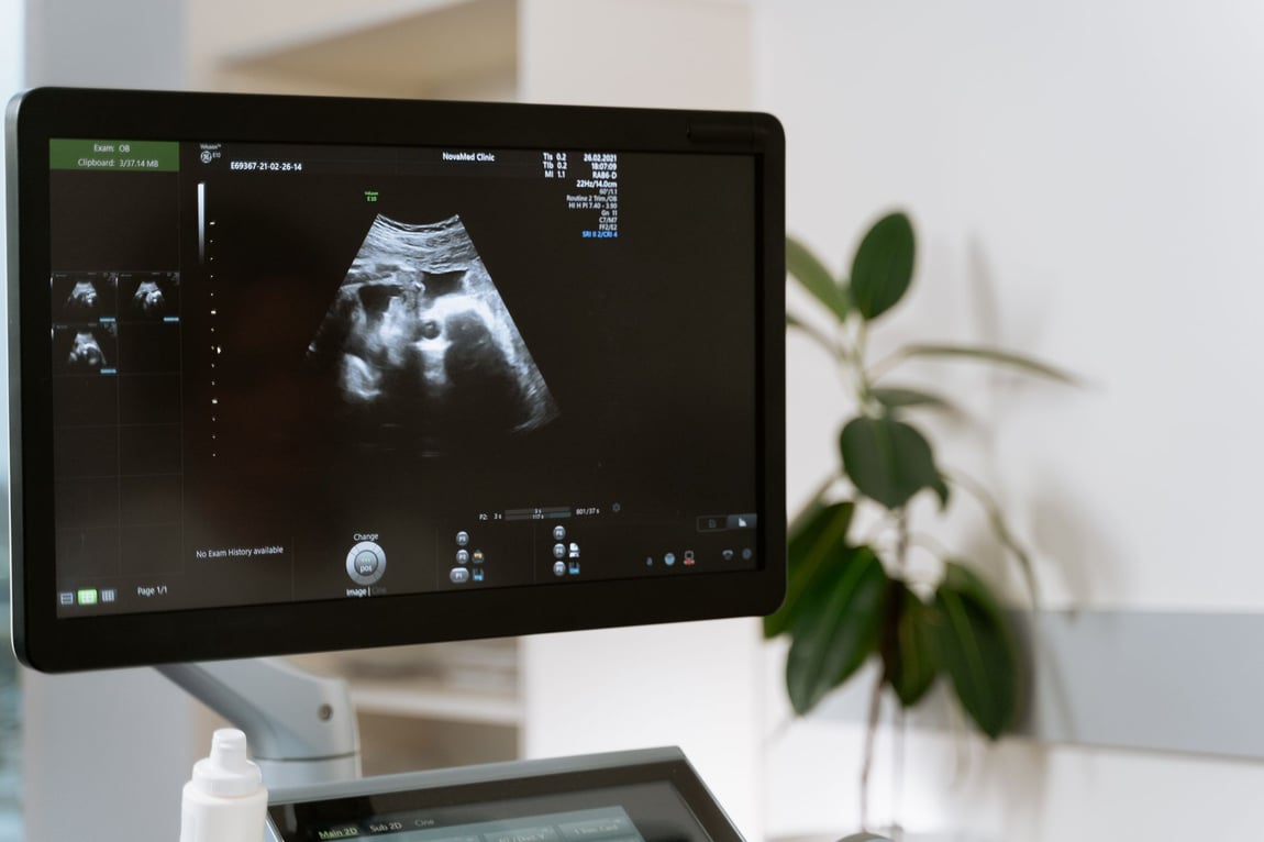 ultrasound monitor showing fetus